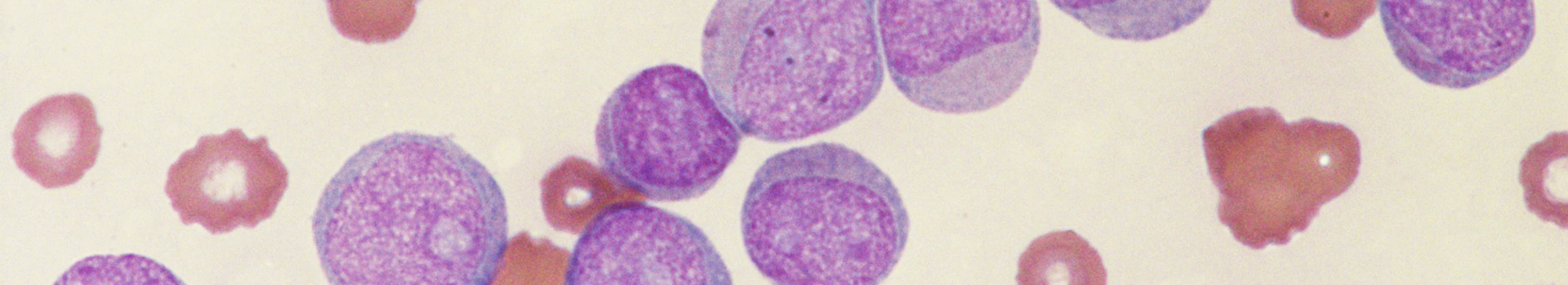 What is acute lymphoblastic leukemia?